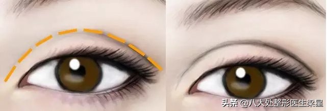 平行式双眼皮变成普通窄双眼皮了,悲伤蛙双眼皮图片