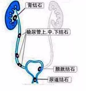 肾绞痛好难受,肾绞痛你痛到哪个程度