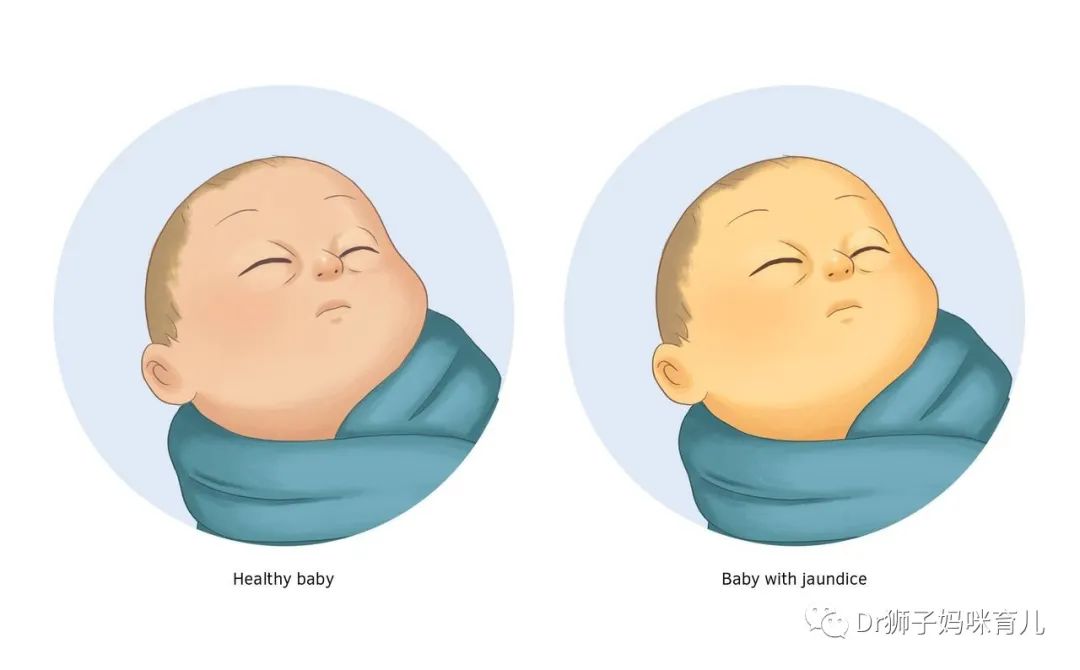 家里有肝病小孩黄疸高,有黄疸的宝宝应该怎么照顾