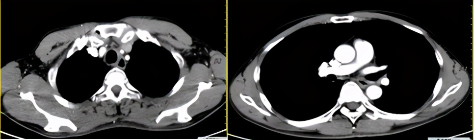 不可切除肺癌肿瘤治疗方法,不可切除晚期治疗什么意思
