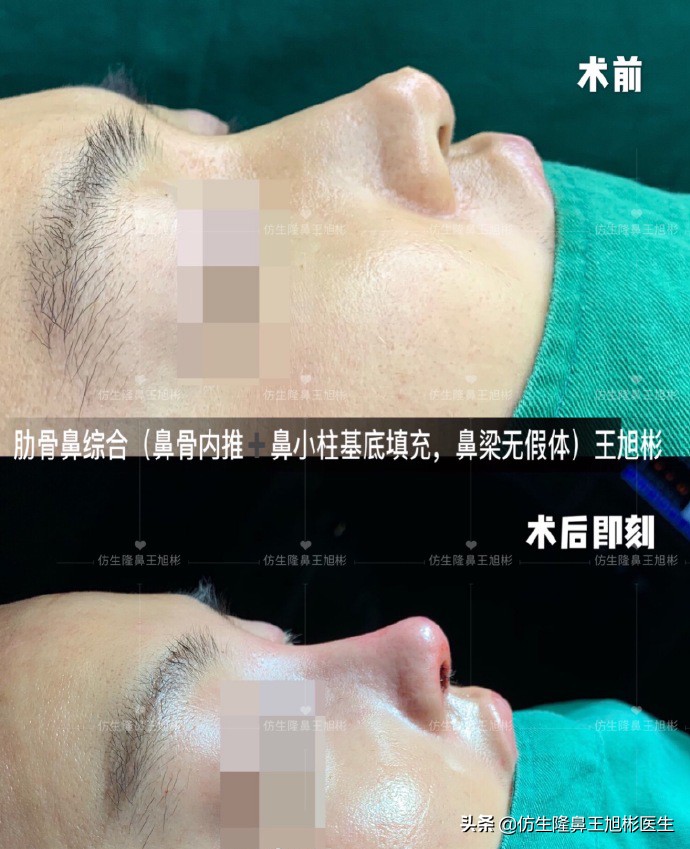 鼻尖整形最简单方法,鼻尖整形的方法图解