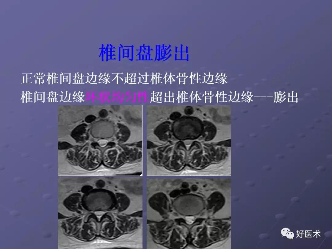 脊柱mri有哪些特点,乳腺疾病的mri诊断及鉴别