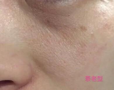 毛孔缩小的方法,草莓鼻怎么去掉还能缩小毛孔