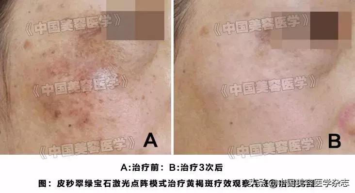 翠绿宝石激光治疗褐斑,褐青色斑激光恢复图