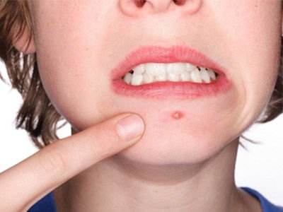 额头长痘一直不好要去医院吗,左右脸颊长痘是肝不好还是脾不好