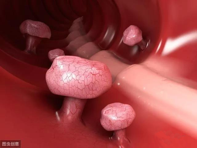 有肠息肉大便时有什么症状,除了痔疮出血还有什么会出血