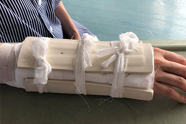 孩子骨折手法复位,孩子骨折了该如何自救