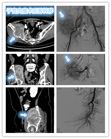 晚期内膜间质肉瘤怎么治疗,低级别子宫内膜间质肉瘤最新研究