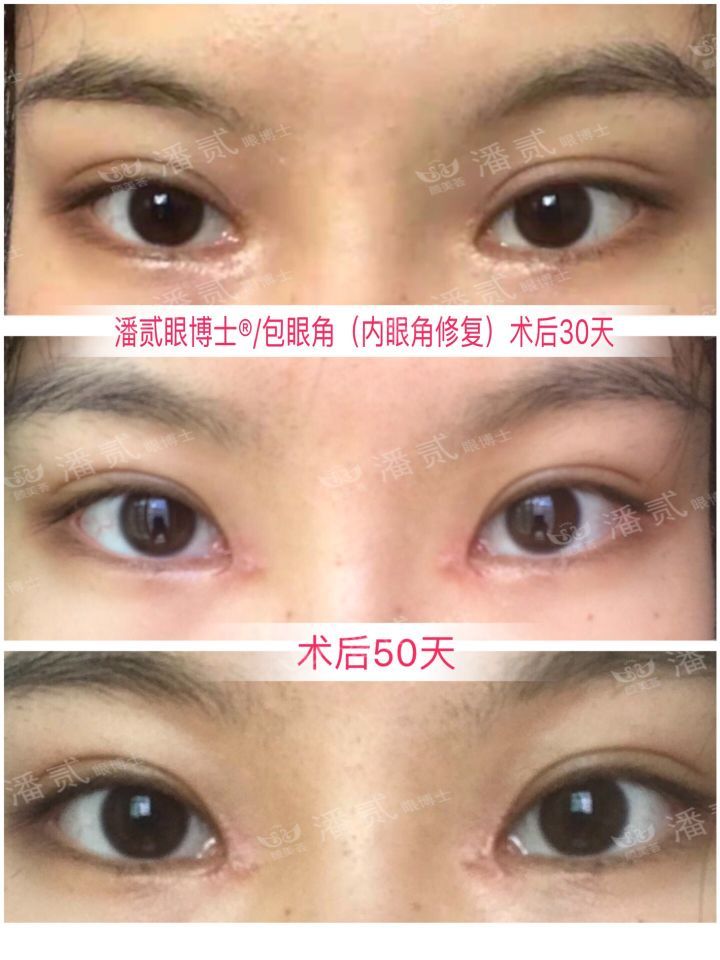 女孩眼部整形失败,内眼角整形失败