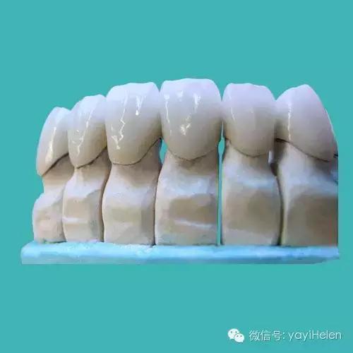 德国3d无铍烤瓷牙能用多久,helen烤瓷牙
