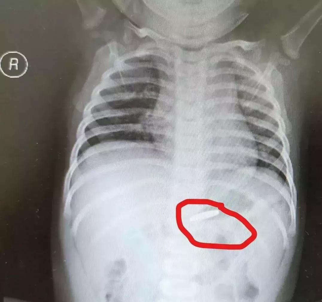 喉管长期被胃酸腐蚀会怎么样,小孩喉管被腐蚀