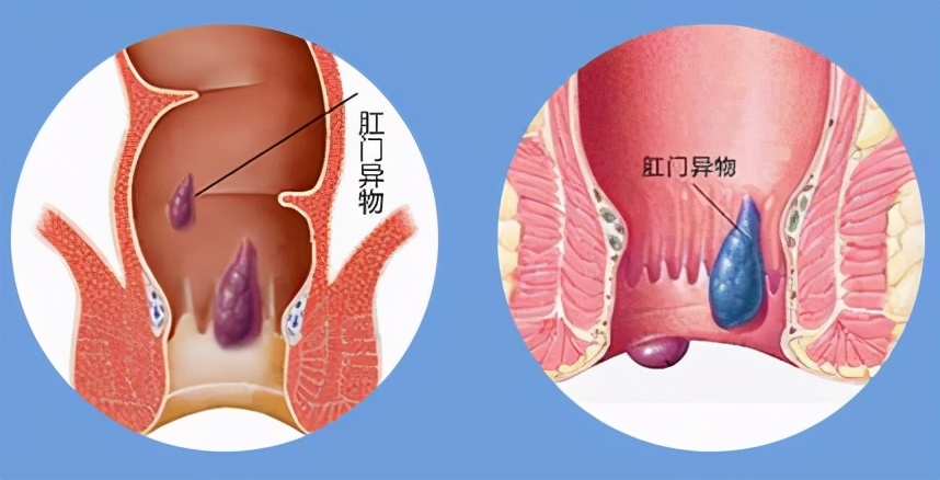 怎样判断是痔疮还是息肉,怎么判断痔疮还是息肉