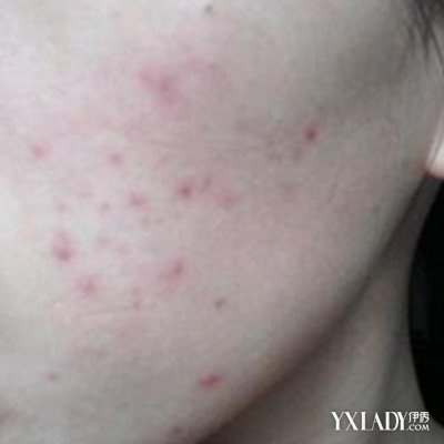 有痘印痘坑黑痘印应该用啥护肤品,脸上痘印太多治疗痘印痘坑的方法