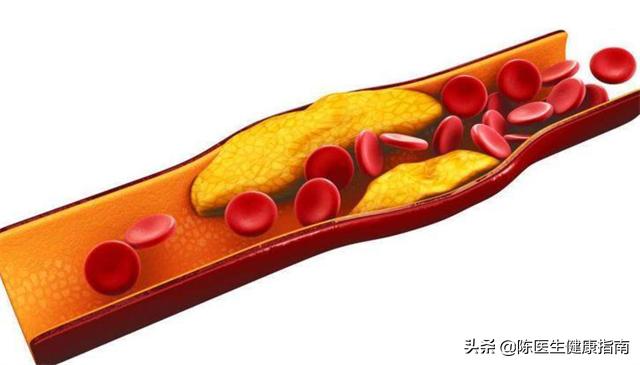 吃硝苯地平水肿如何处理,吃硝苯地平出现水肿副作用