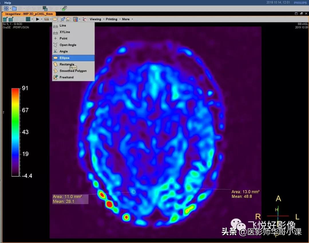 飞利浦磁共振快速扫描方案指南,飞利浦1.5t磁共振各部位扫描技术