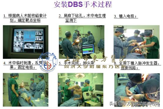 dbs治疗帕金森术后用不用吃药,dbs手术延缓帕金森痴呆