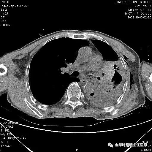 手术引起乳糜胸,有没有做了肺结节手术后是误诊的
