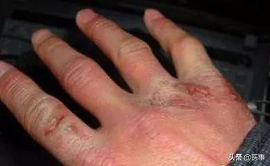 专治冻疮特效穴,冻疮有特效膏药吗