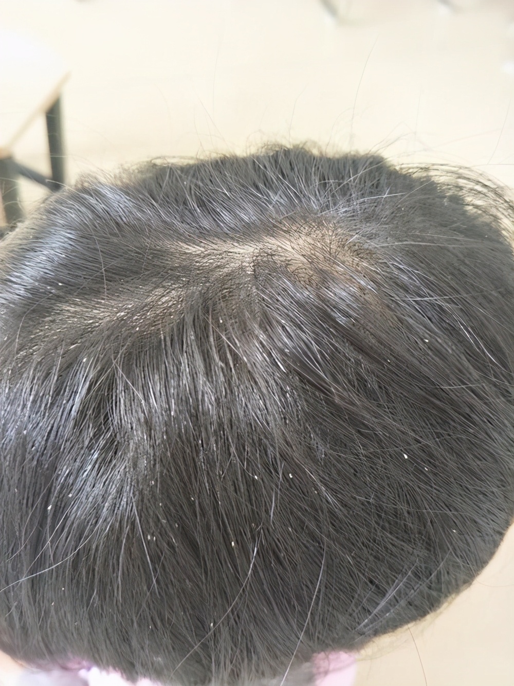 陕西渭南：一幼儿园女孩染头虱，奶奶用夹板烫死30多只