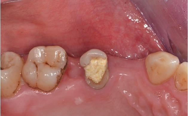 单颗门牙缺失牙桥修复,固定桥修复缺失牙