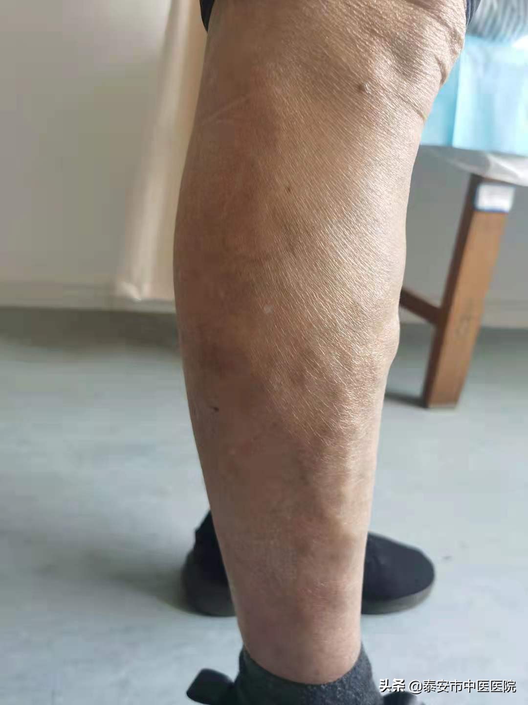 中医治疗下肢静脉曲张消除蚯蚓腿,微创闭合大腿根治静脉曲张过程