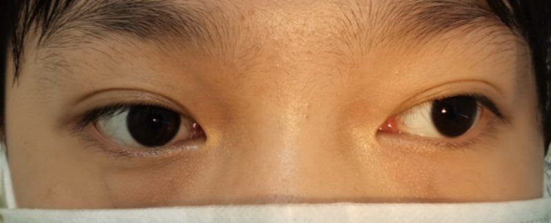 斜视手术吓人吗,斜视手术危险么