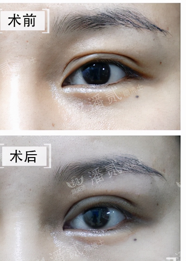 韩式精雕微创双眼皮,韩式微创双眼皮恢复过程真实记录
