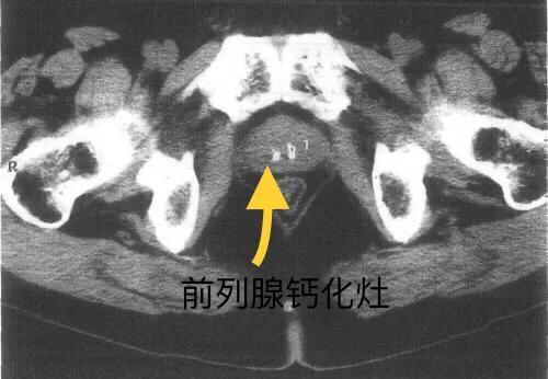 前列腺钙化灶可以用冲击波治疗吗,前列腺钙化灶尿频尿痛怎么治疗