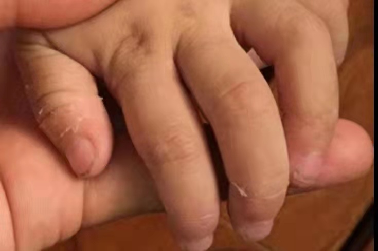 川崎病婴儿自述,3岁女童确诊死亡