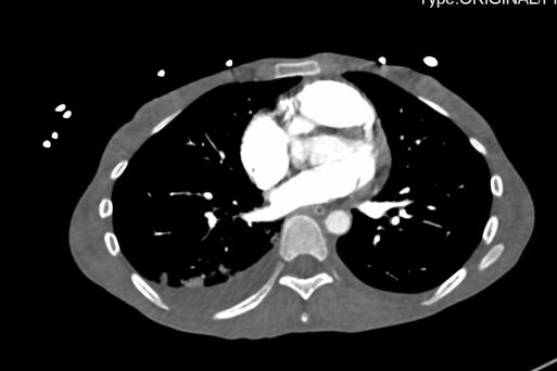 消化道出血高钾血症治疗,诊断高碳酸血症的金标准是什么