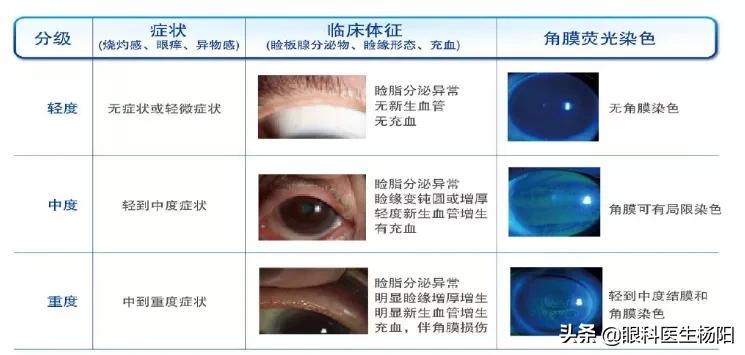 睑板腺一点都没有是什么病,眼睛睑板腺消失严重不