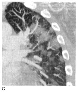肺实变和肺炎的影像学区别,肺实变图