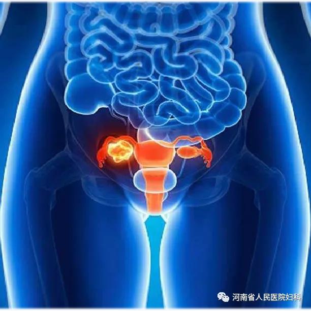 揭秘卵巢癌系列三