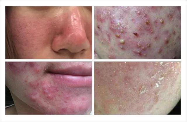 脸上螨虫的正确消灭方法,脸上的螨虫能不能彻底消灭