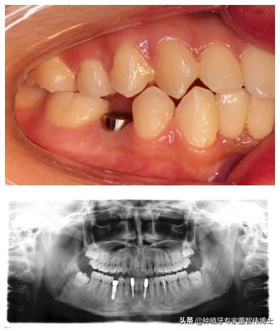 拔牙后即刻种植好还是延期种植好,拔牙后牙槽骨突的修复术视频