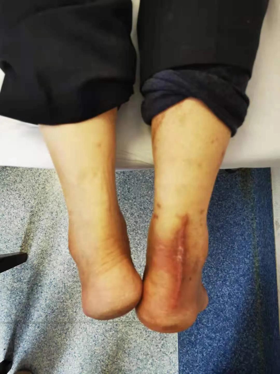 跟腱术后拉长了、没劲了，为什么？——足跟垫的重要性