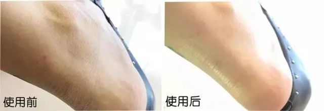 夏天了手脚干裂还有老茧,手脚干裂脱皮老茧用什么药膏