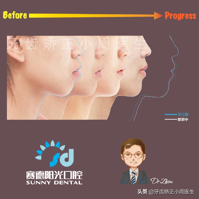 下巴后缩整容玻尿酸还是假体,如何不靠整容改变下巴