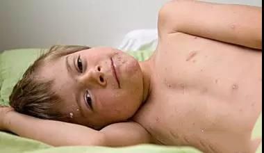 小孩皮疹湿疹水痘有什么区别,幼儿急疹出的疹子是水痘吗