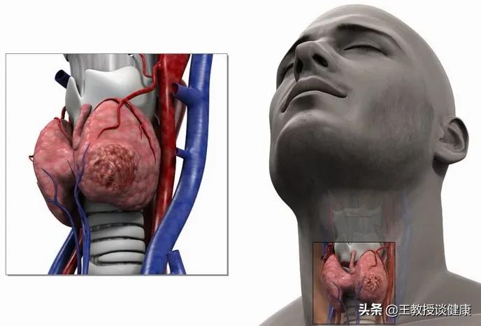 甲状腺癌全切还会复发吗,甲状腺癌全切之后会复发和转移吗