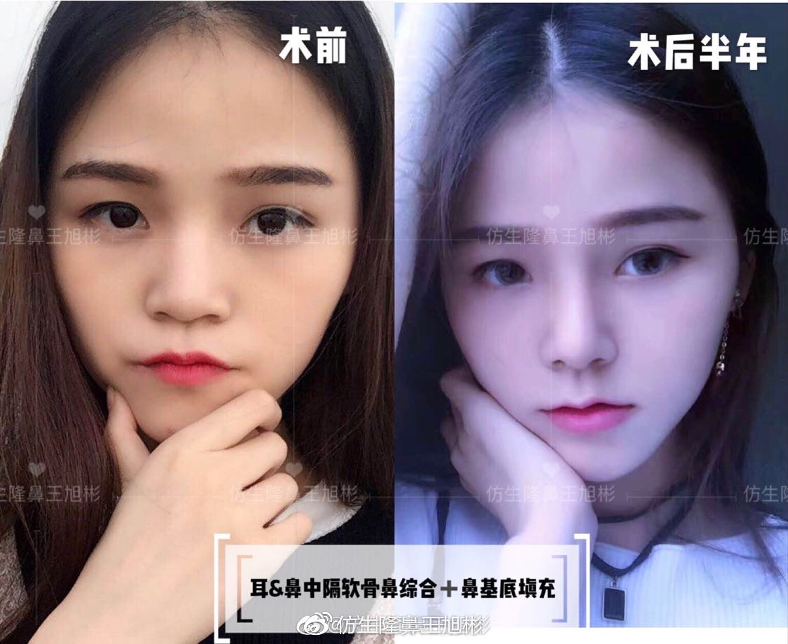 短鼻蒜头鼻整形,短鼻延长术切口