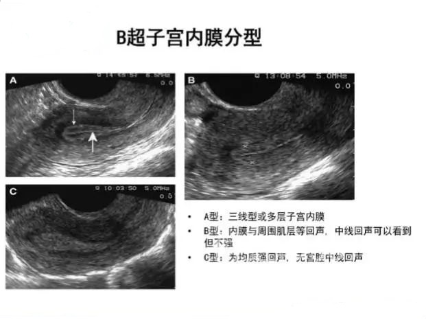 b超检查内膜回声不均是怎么回事,b超子宫内膜回声不均是怎么回事