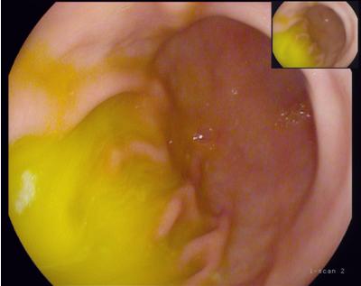 胆汁反流性胃炎到底有哪些原因,胆汁反流性胃炎的快速解决方法
