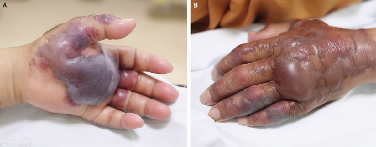 洗虾的时候被扎伤了,洗虾被扎手多大概率死亡