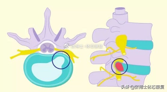 颈椎间盘突出康复训练,颈椎间盘突出康复操完整版