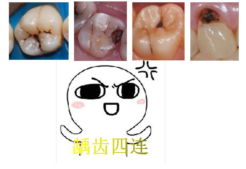 牙齿龋坏了一大半怎么修复,牙齿龋坏了怎么办