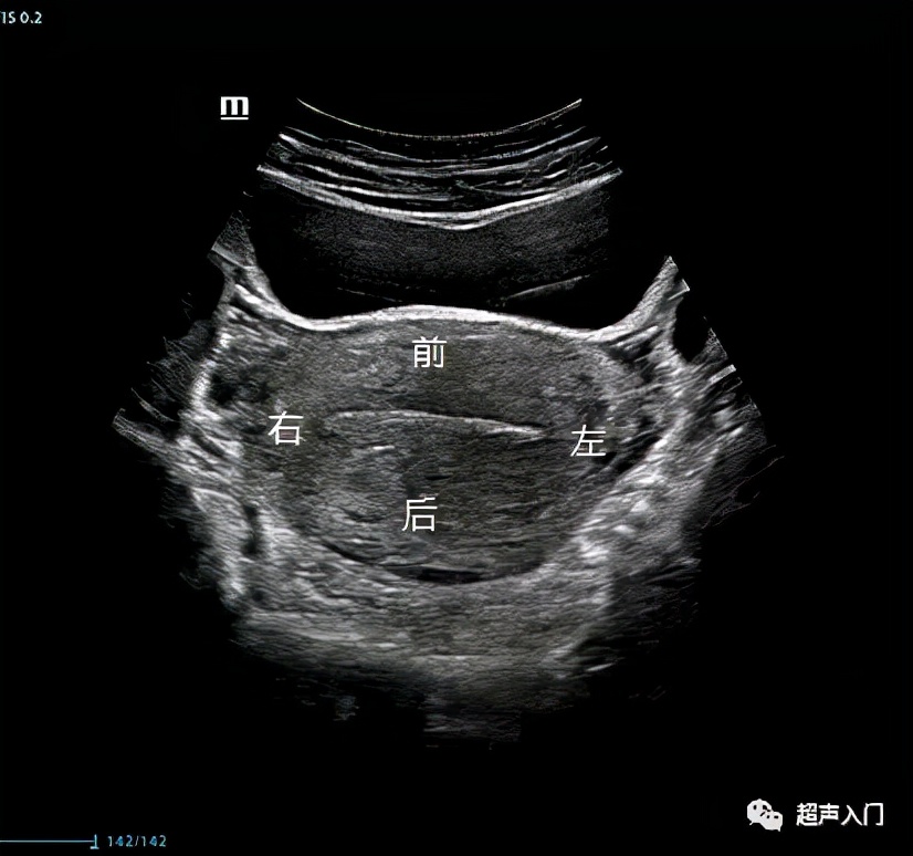 超声怎么分辨前后位子宫,超声如何区分子宫前后位