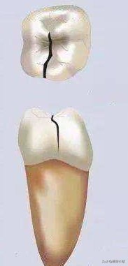 牙齿问题困扰和误区,不容忽视的牙齿问题