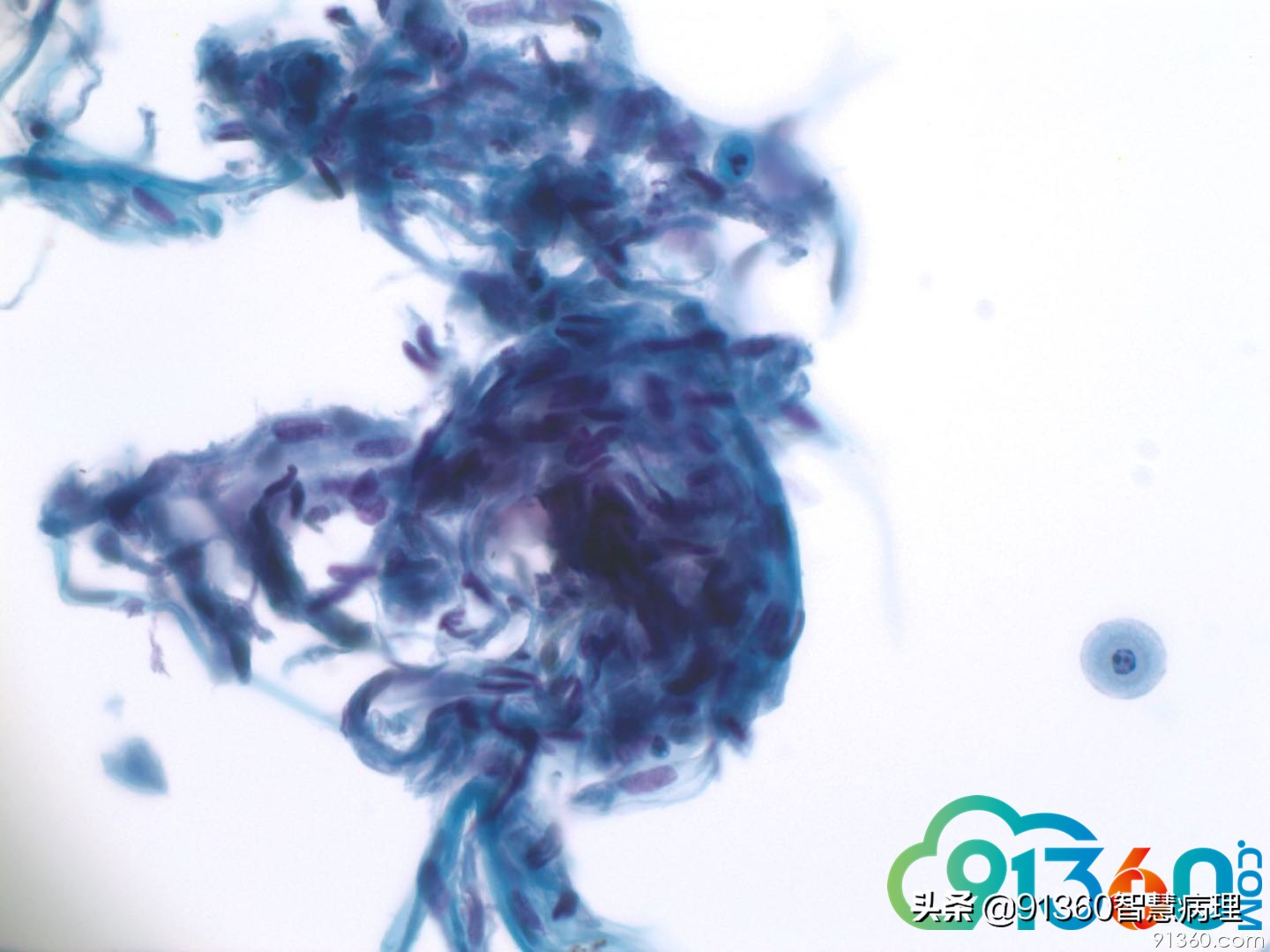 宫颈病理tct是什么检查,tct出现ascus会是宫颈癌吗