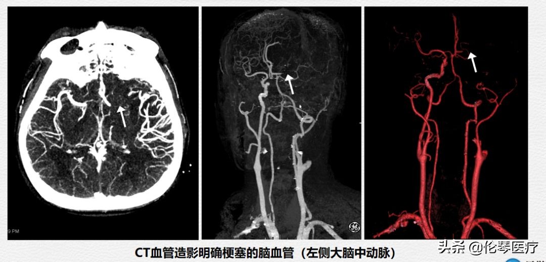 伦琴医疗核心专家王悍教授：脑中风是怎么回事，如何预防与治疗？